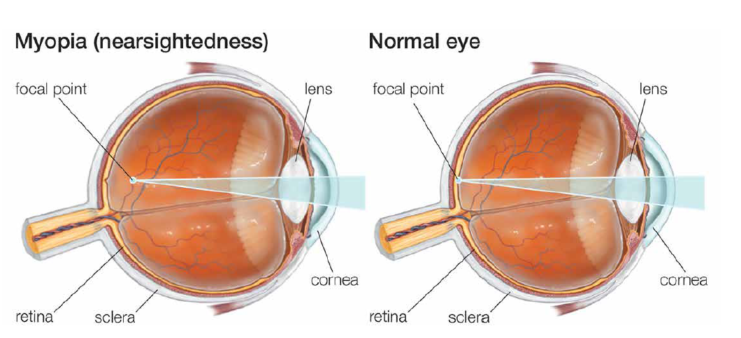 Eye Strain - Symptoms and Solutions - Irish Pharmacy News